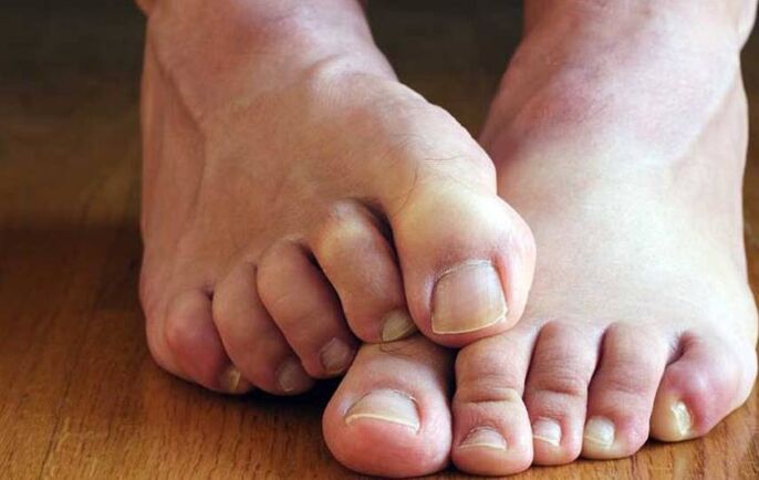 plokščiojo grybelio simptomai ant kojų