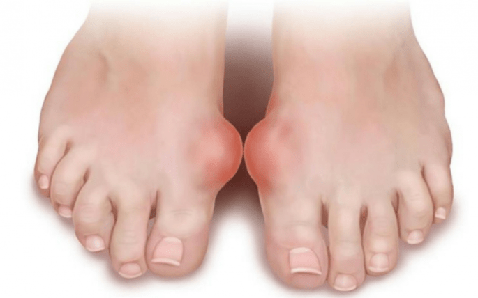 pėdos deformacija, kaip grybelio atsiradimo ant kojų priežastis