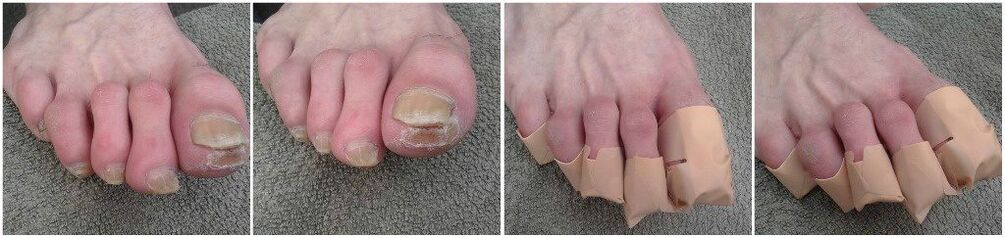 Kojų nagų grybelio pleistrų klijavimas