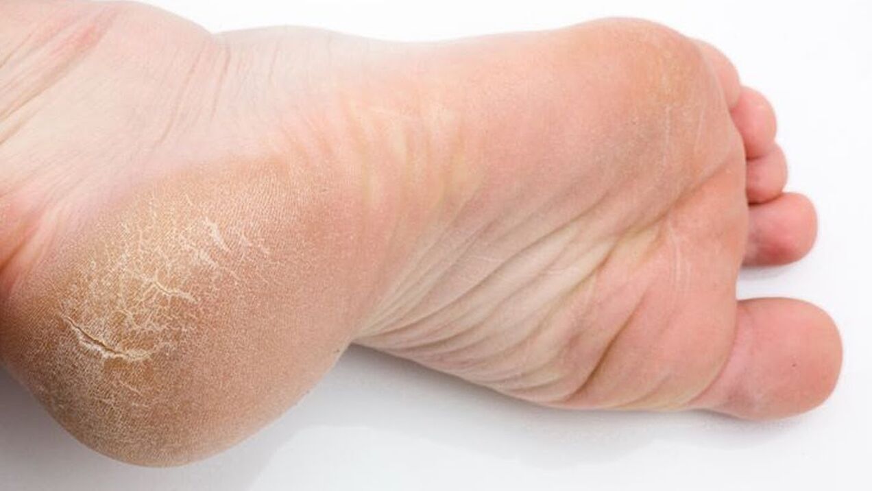 grybelis ant kojų odos
