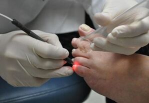 Kojų nagų grybelio gydymas lazeriu