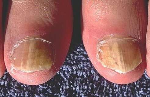 Nagai, paveikti dermatofitų