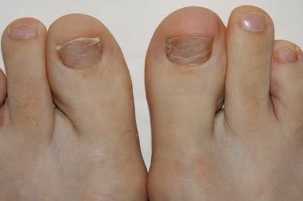 Simptomų atsiradimo grybelis ant kojų